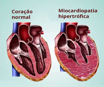 miocardiopatia-hipertrofica-o-que-voce-precisa-saber-sobre-essa-doenca-cardiaca-de-origem-genetica